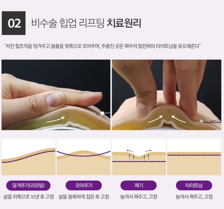 자가지방 광주힙업성형, 생착률에 영향을 주는 요인들
